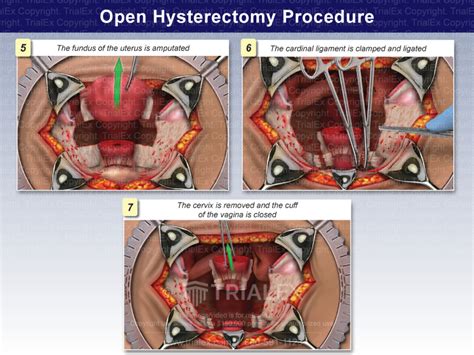cost of hysterectomy procedure in the philippines|OPEN HYSTERECTOMY .